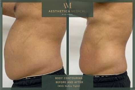 body sculpting brookside|Body Contouring .
